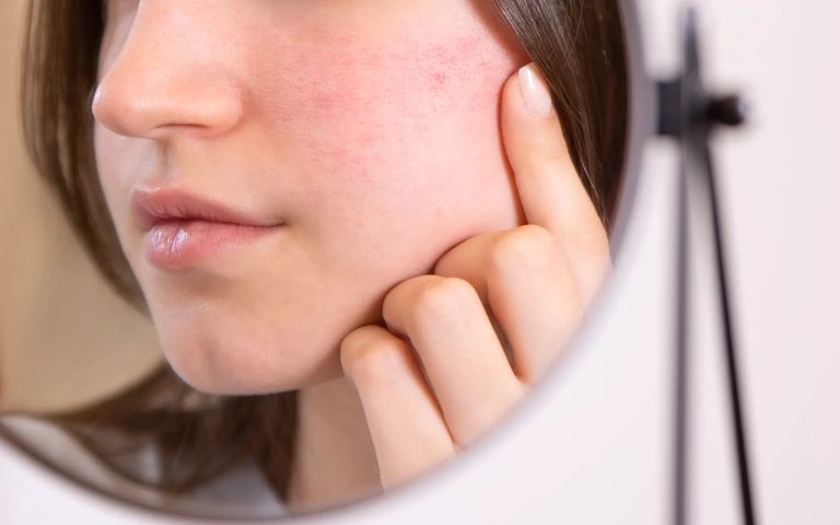 Rosacée & Couperose : Comprendre Et Accompagner Au Naturel